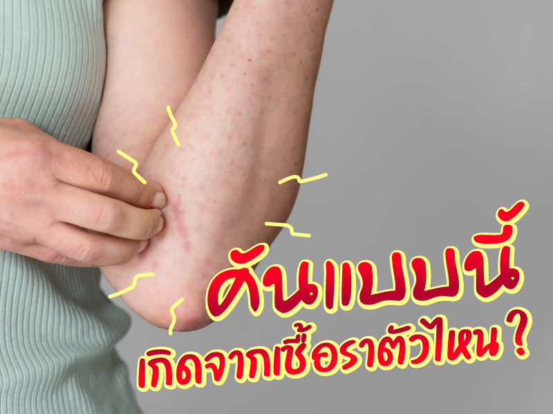 อาการคันแบบนี้ เกิดจากเชื้อราชนิดไหน ?